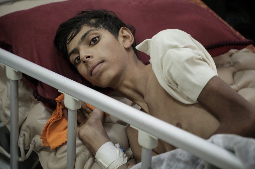 Rafeeq Dughmoush, 16, lies in a hospital bed in Gaza City. "I am emaciated," he said. (Mohammed Shahin/BBC)