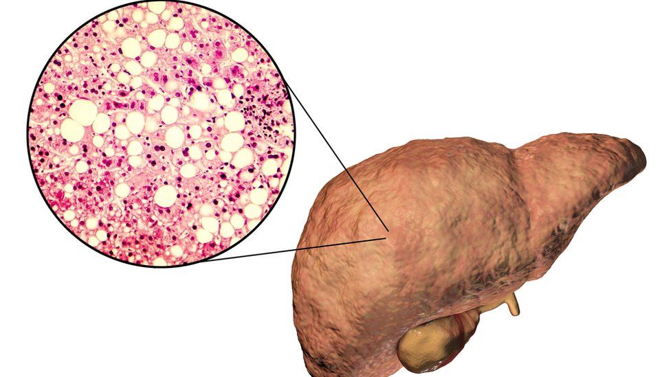 Diagram of how a fatty liver looks