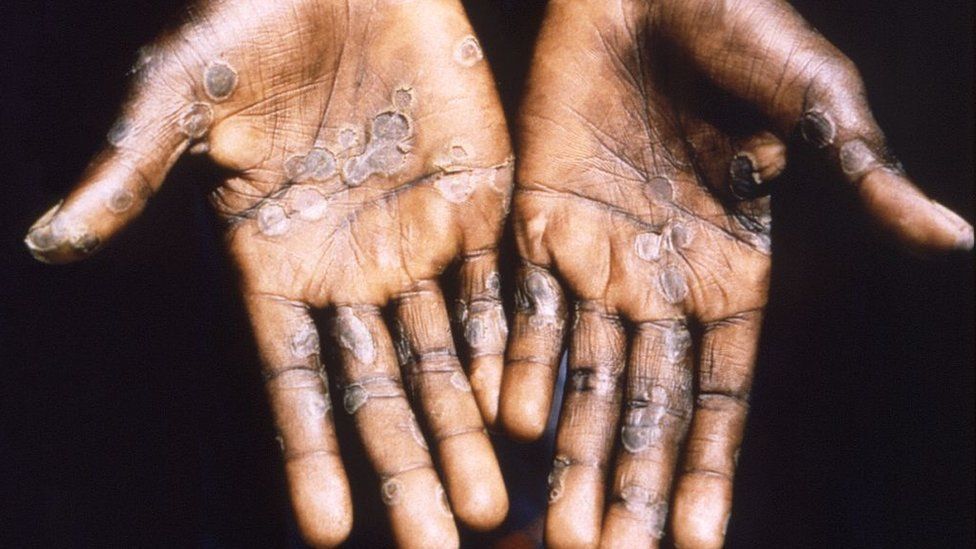 Monekypox lesions on hands