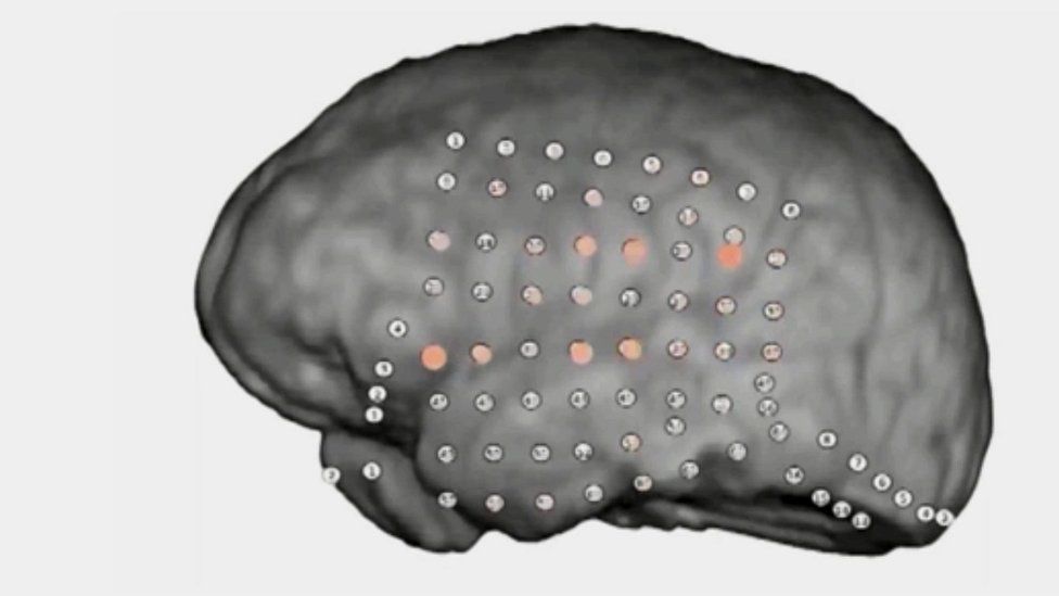 Patterns of activity on animated human brain undergoing auditory test
