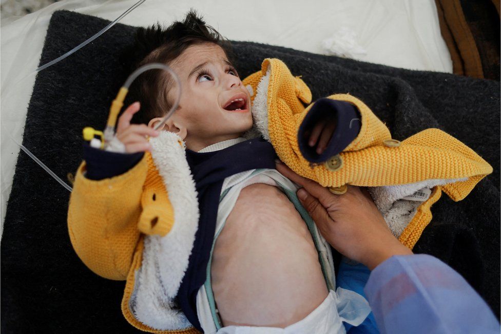 A Palestinian boy suffering from acute malnutrition is treated in Rafah, Gaza.