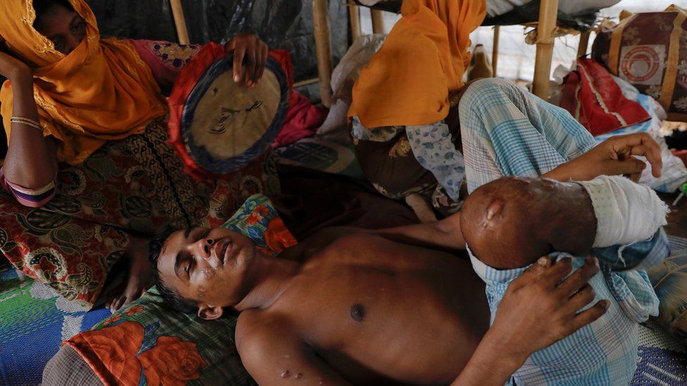 Rohingya landmine victim in a Bangladesh refugee camp