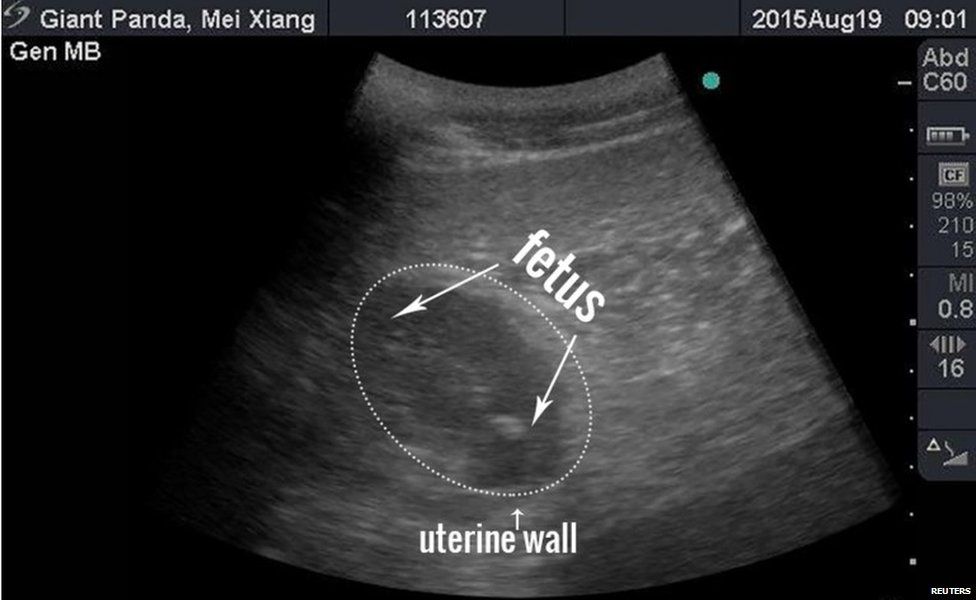 An ultrasound image showing a foetus
