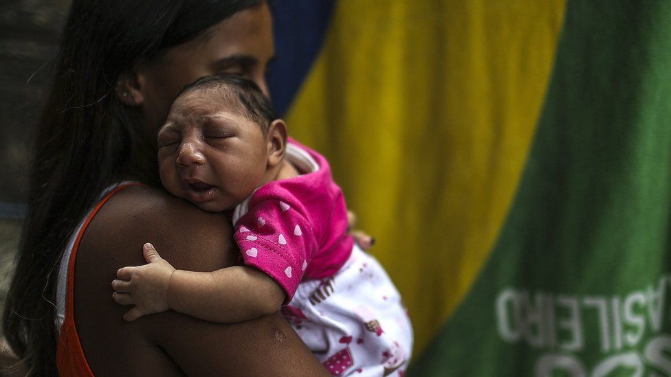 Mother holding her daughter, born with microcephaly from the Zika virus