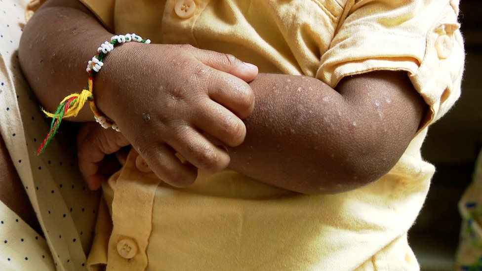 A child scratches a rash on his arms