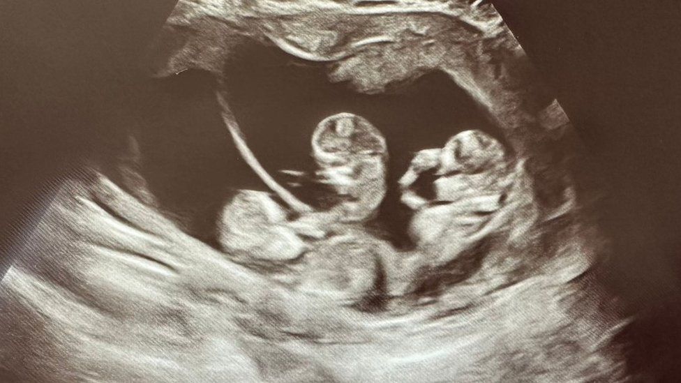 Ultrasound scan of the triplets