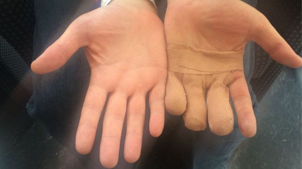 Jamie Clark's injured hand