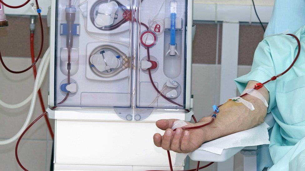 An arm of a patient receiving dialysis