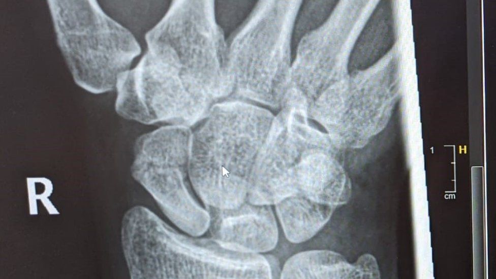 Radiografía de la mano de Louise Ketteringham