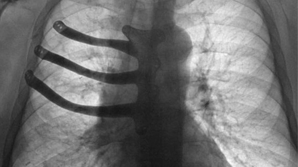 An x-ray of Peter Maggs' chest showing the implant