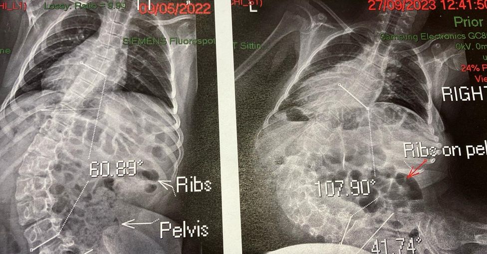 X-rays of Eva's spine show the curvature has worsened without the operation