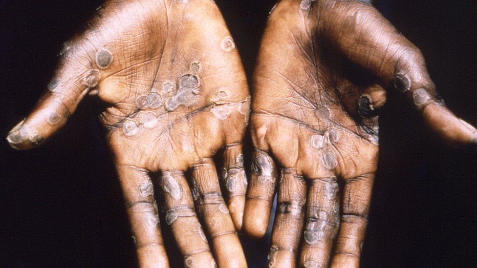 Palms of a monkeypox case victim