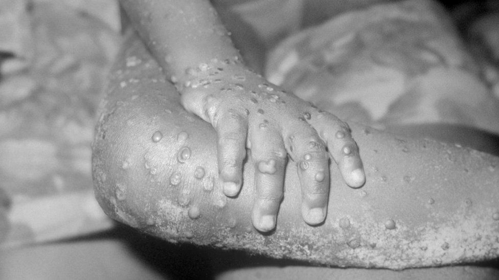 The arms and legs of a girl with monkeypox in Liberia