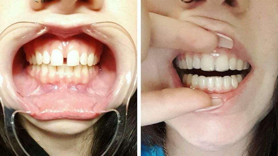 College Student Clear Aligners Smile Direct Club  Discount April 2020