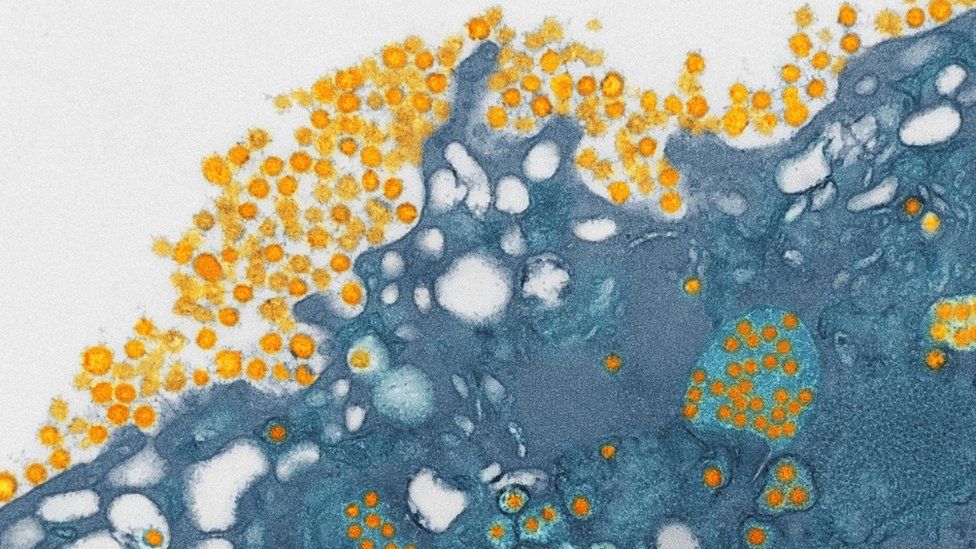 Mers coronavirus. Coloured transmission electron micrograph (TEM) of Mers coronavirus particles (orange) budding from a host cell (blue)