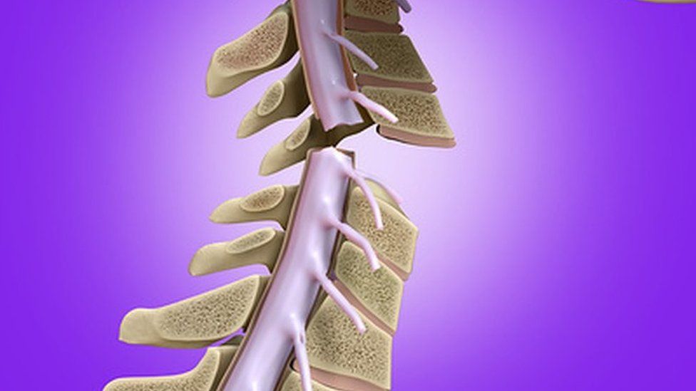 Spinal cord damage