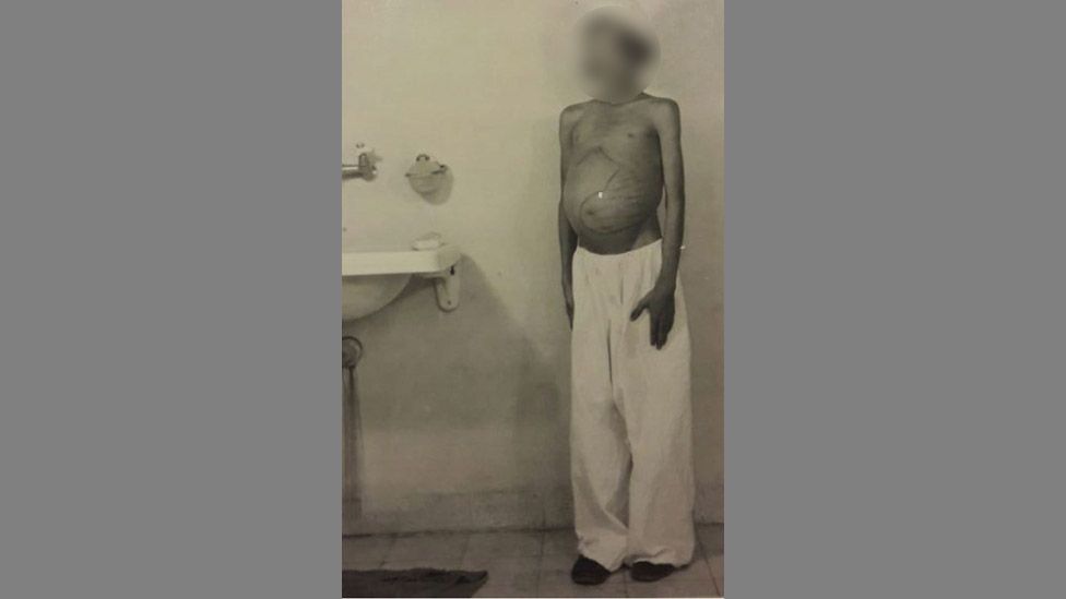 A disturbing photograph shows a malnourished child in hospital with the location of the spleen marked on their body in pen