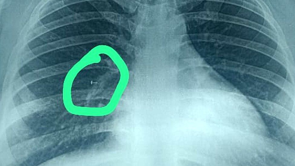 The X-ray showed the nose pin embedded in the lung