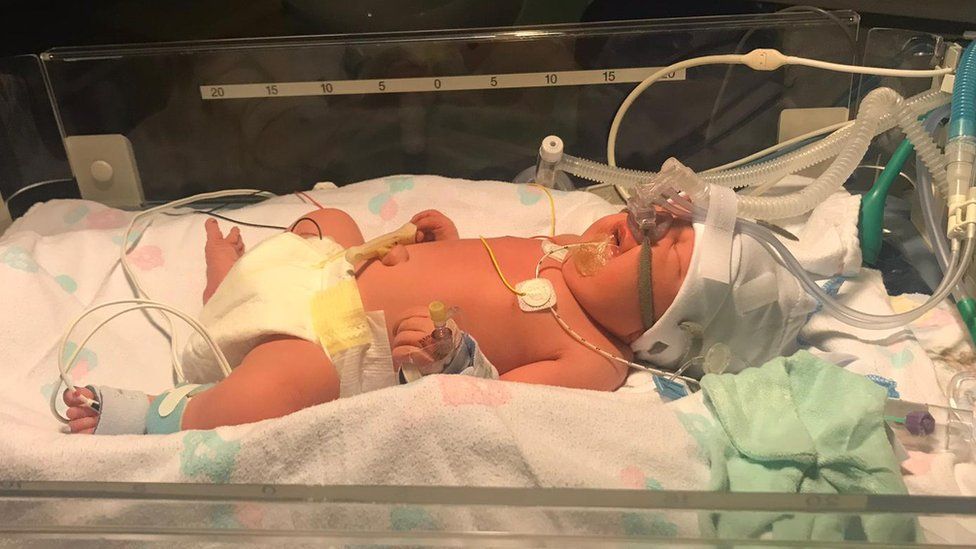 Infant Thea in hospital crib with oxygen tubes