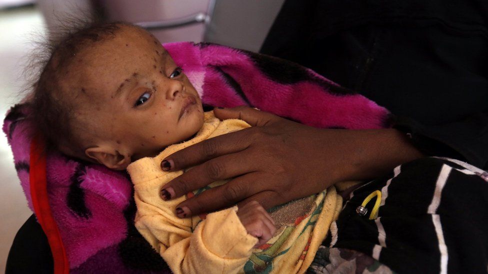 A Yemeni woman holds her malnourished child receiving treatment amid worsening malnutrition at a hospital in Sana"a, Yemen, 24 November 2017.