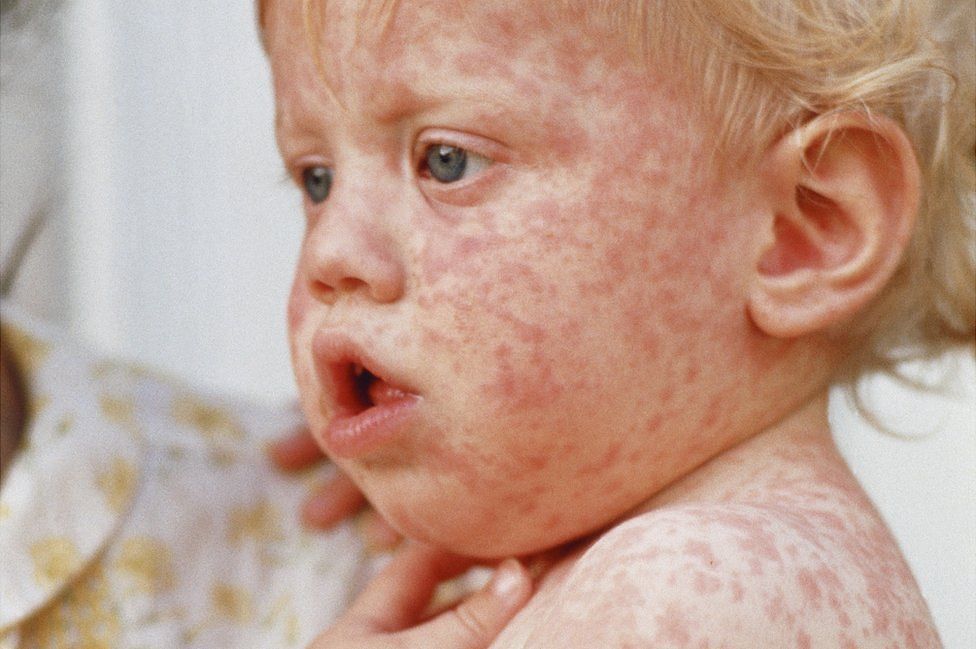 Infant with measles rash - file pic