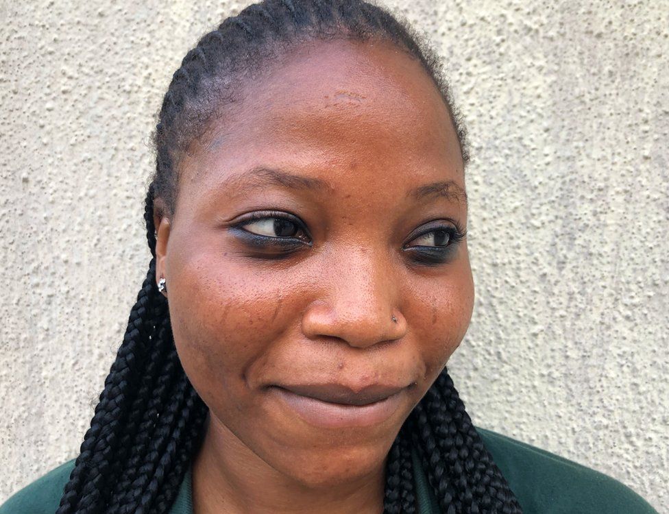 A woman with scars on her face