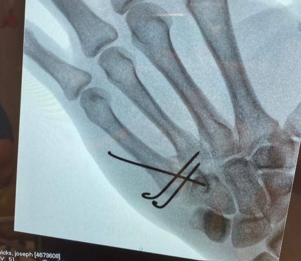X-ray of his hand