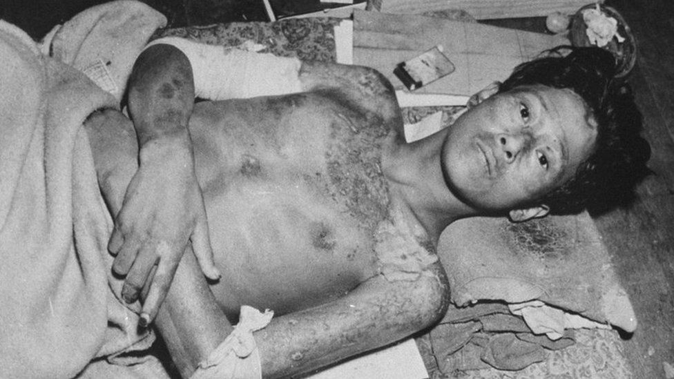 A victim of the atomic bomb explosion in 1945 over Nagasaki, Japan.
