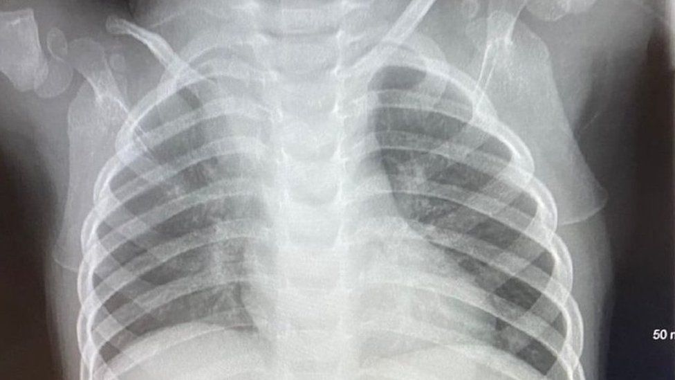 Röntgenaufnahme von Archies Brustkorb mit teilweise kollabierter Lunge