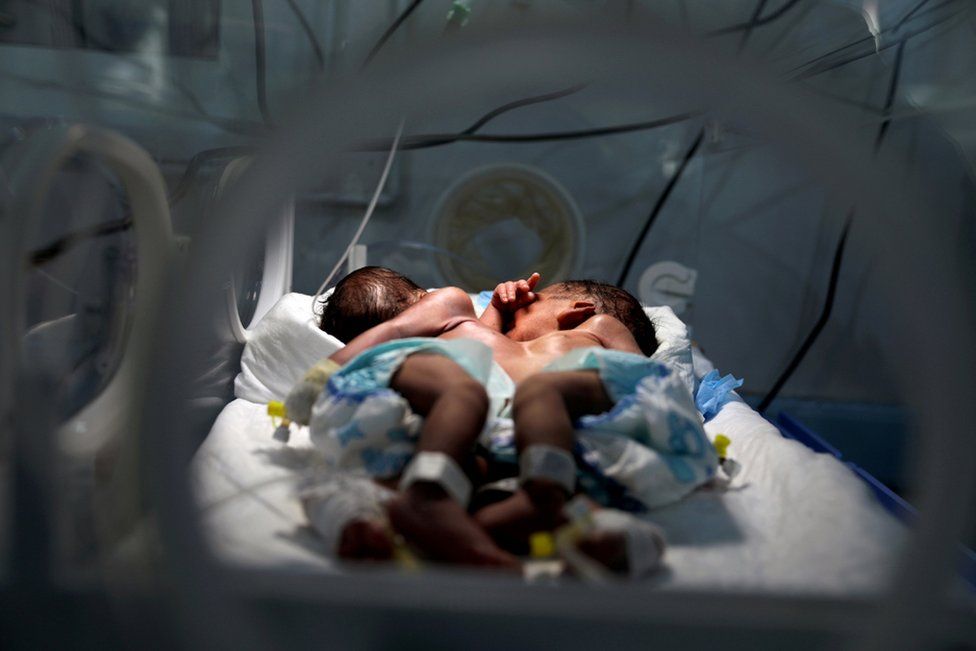 Newly born conjoined twins lie in an incubator at the child intensive care unit of al-Sabeen hospital in Sanaa, Yemen, 18 December 2020