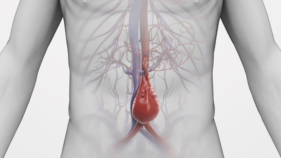 Illustration of an abdominal aortic aneurysm