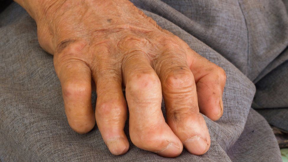 Hand with leprosy