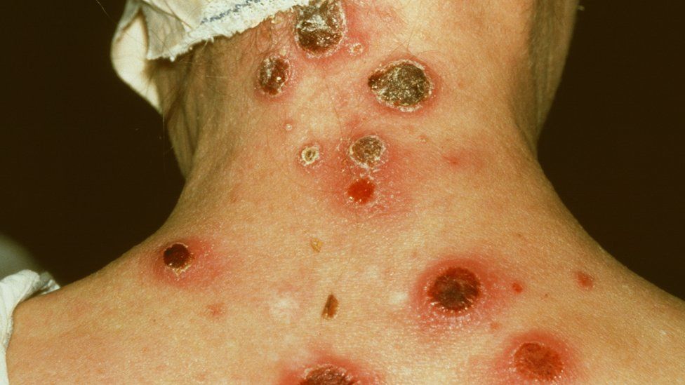 Secondary syphilis rash and inflammation on a back