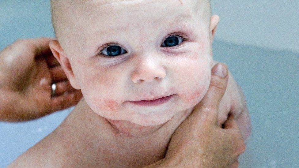 Baby with eczema