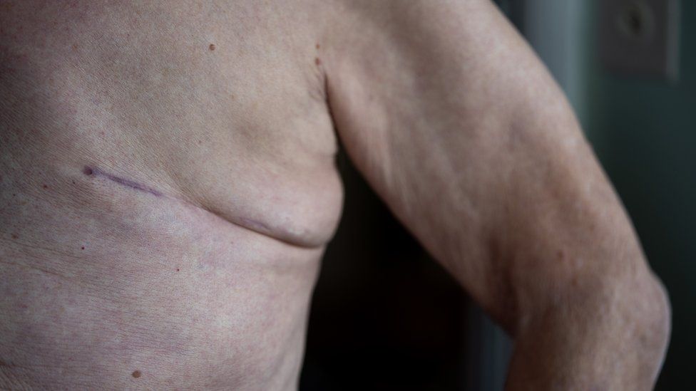 Mark James' breast surgery scar