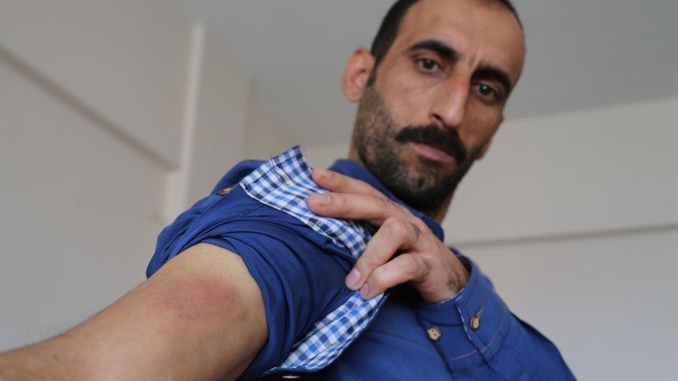 Kamil Uluc shows burn mark to his arm, allegedly by torture