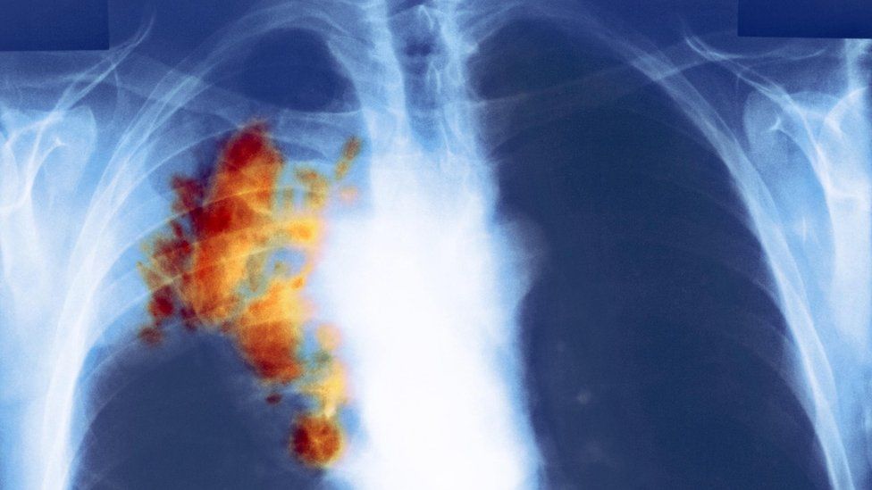 An x-ray showing lung cancer