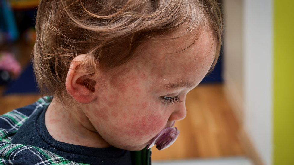 Stock photo of a child with a measles rash