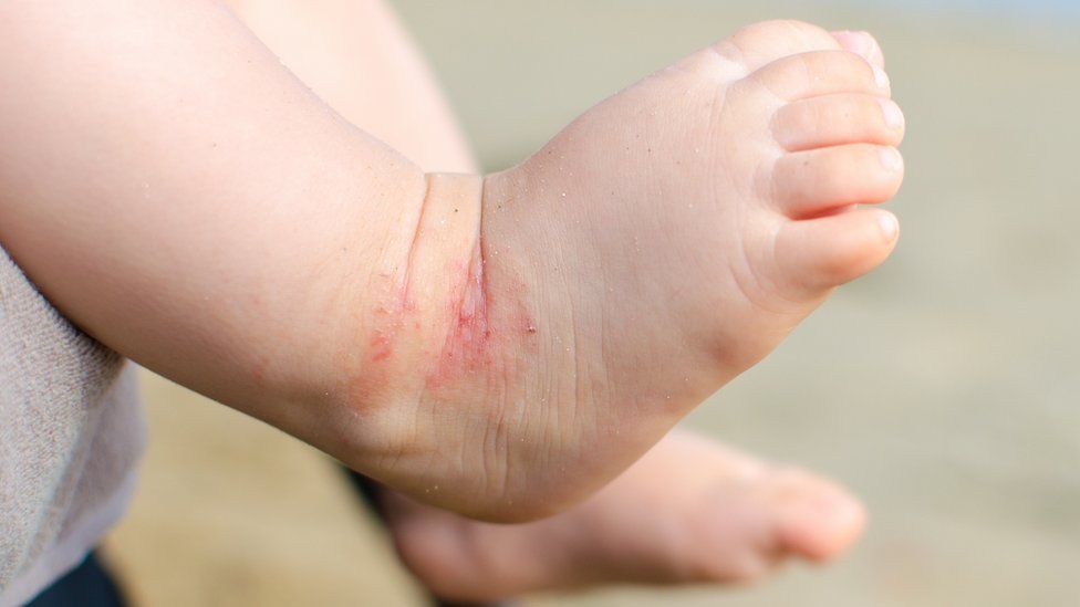 A baby with eczema