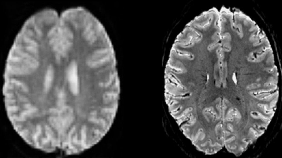comparison of brain scans
