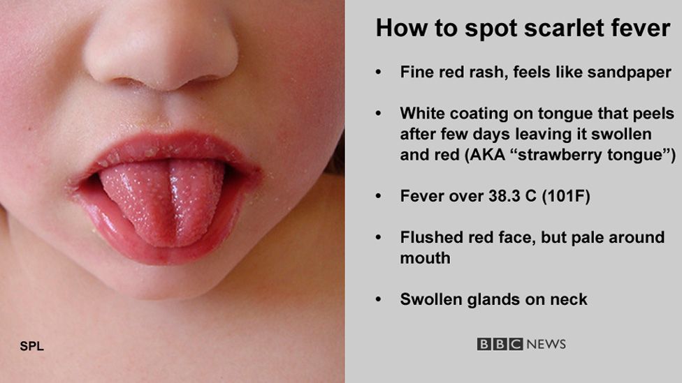 scarlet-fever-case-numbers-on-the-rise-in-northern-ireland-bbc-news