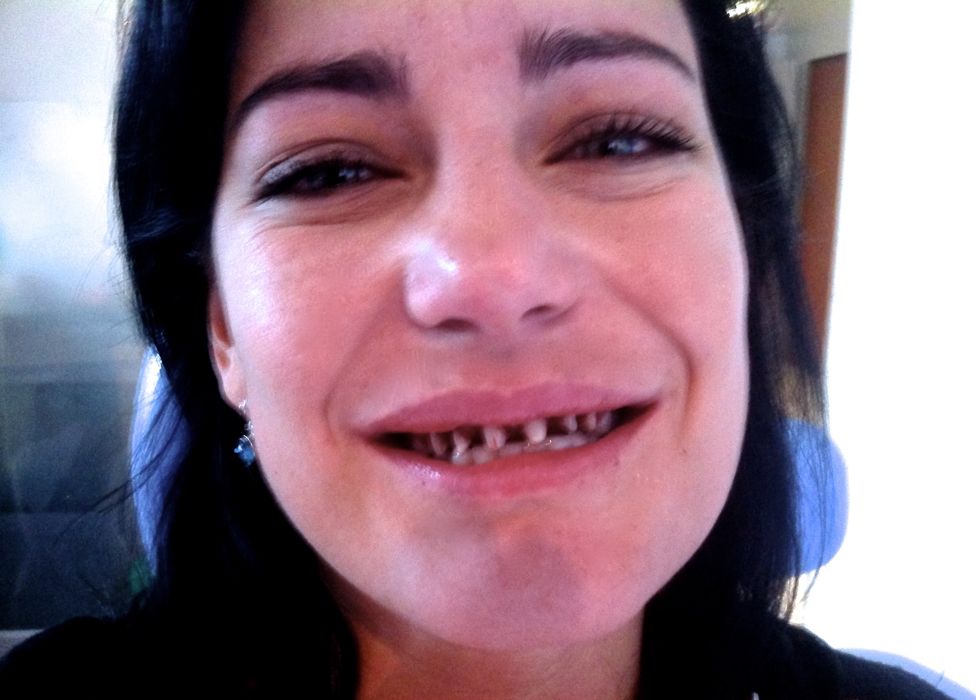 Natalia's teeth shaved down