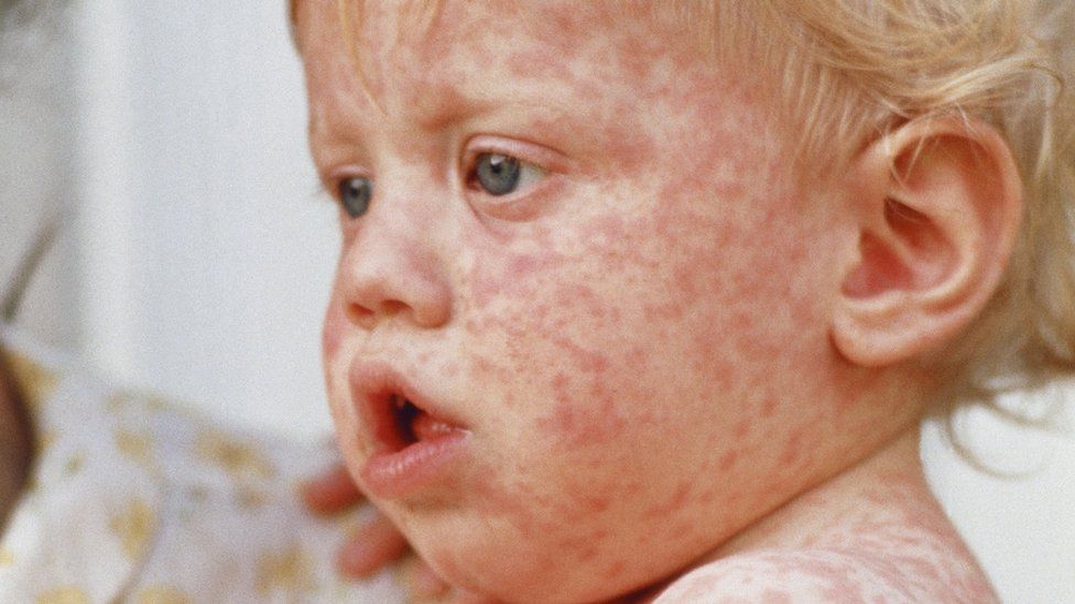 A child with measles