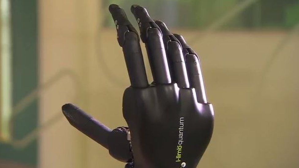 The i-limb quantum hand
