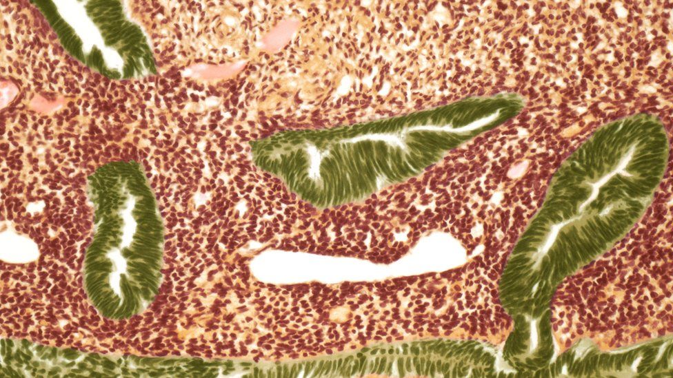 сканирование раковых клеток матки