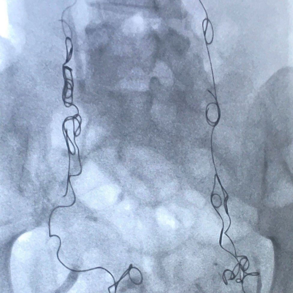 X-ray of Sophie Robehmed's embolisation