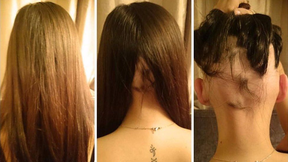 Comparison of the back of Jade's hair-loss over time