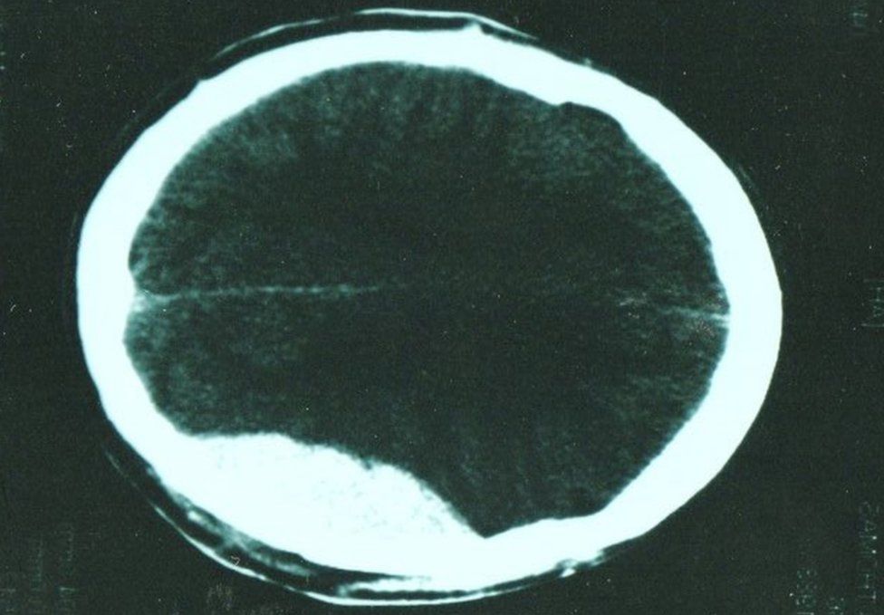 Thomas Leeds's brain scan showing the bleed
