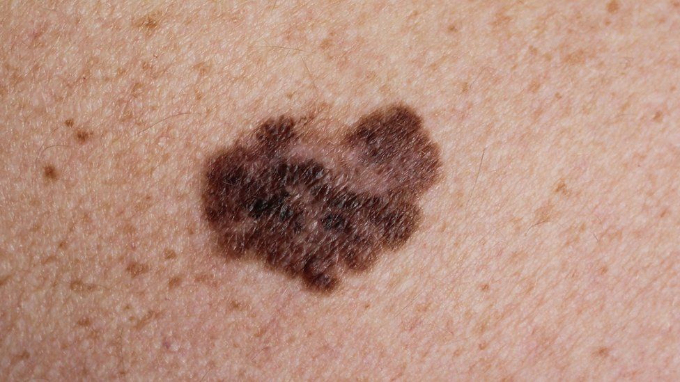 An example of a cancerous mole on the skin