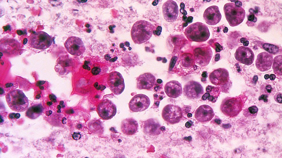 Light micrograph of a brain tissue specimen in a case of a Naegleria fowleri amoebic infection